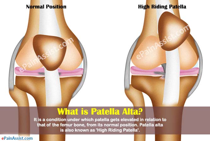 Patella Alta Meaning In English